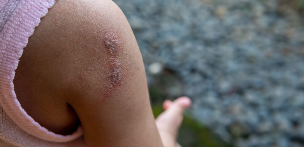 impetigine