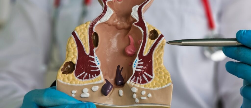 sangue nelle feci santagostino nembro