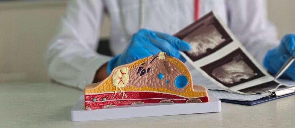 mammografia santagostino nembro