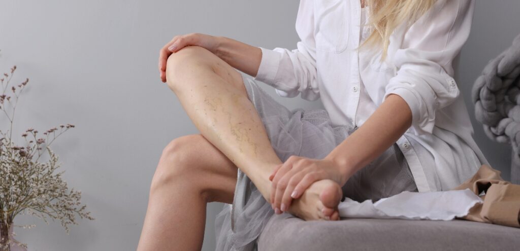 trombosi venosa profonda