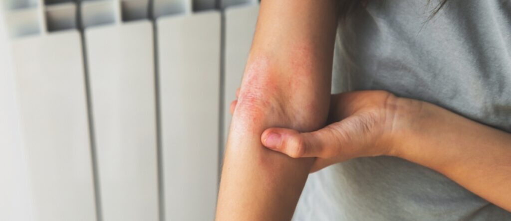 dermatite atopica santagostino nembro