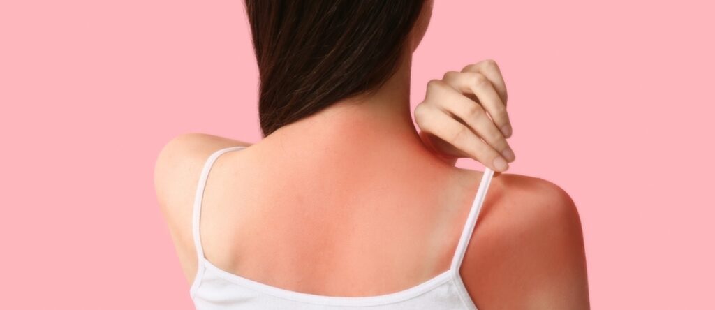 eritema santagostino nembro