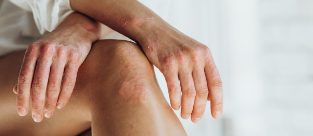 psoriasi santagostino nembro