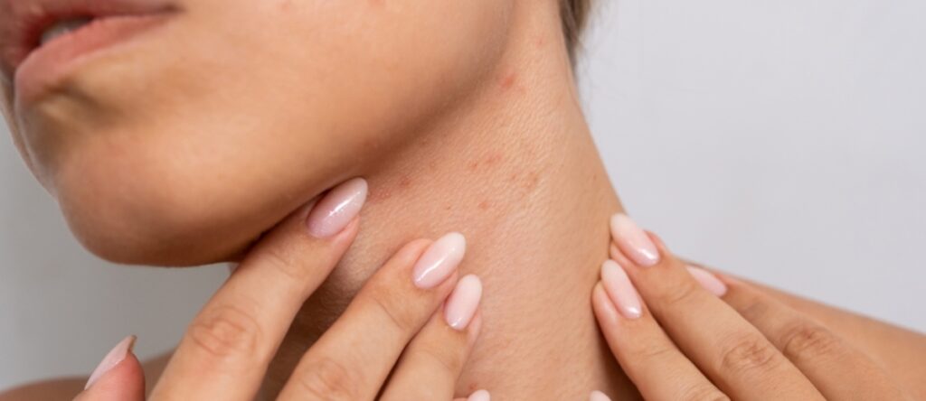 rash cutaneo santagostino nembro