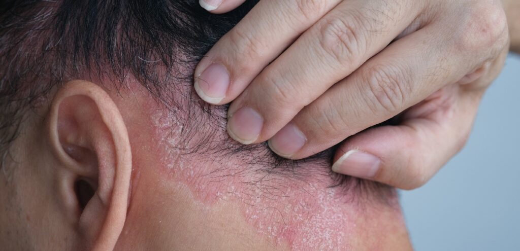 desquamazione cuoio capelluto