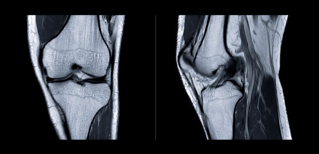 risonanza magnetica ginocchio