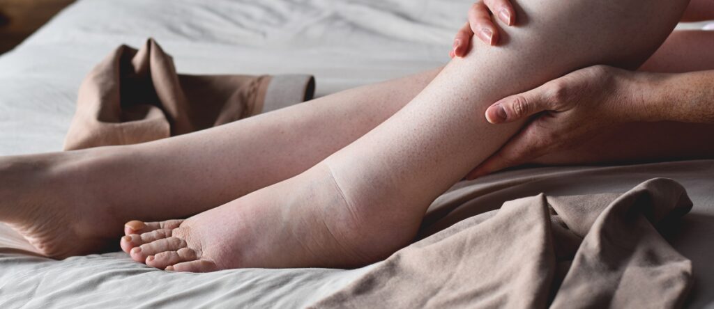 gambe gonfie santagostino nembro