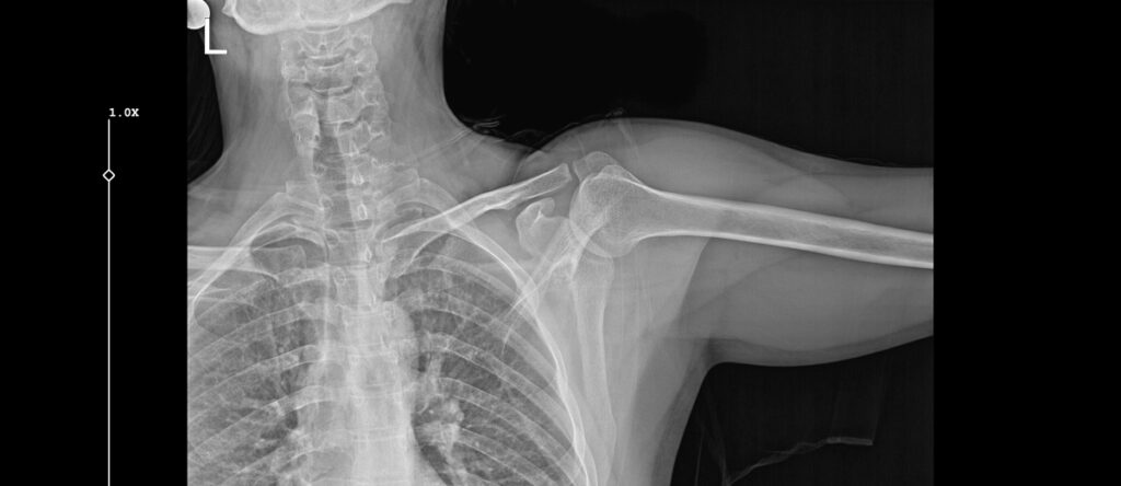 radiografia spalla santagostino nembro