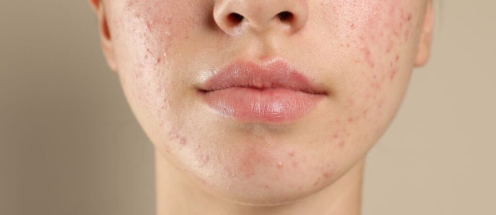 acne nembro